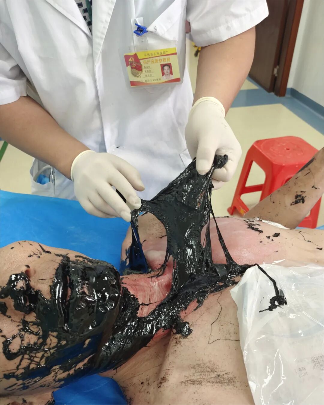 梅州一人被柏油烧伤！画面触目惊心-小辉娱乐网