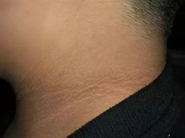 脖子上出现这3种东西，说明癌细胞已经醒了！-小辉娱乐网