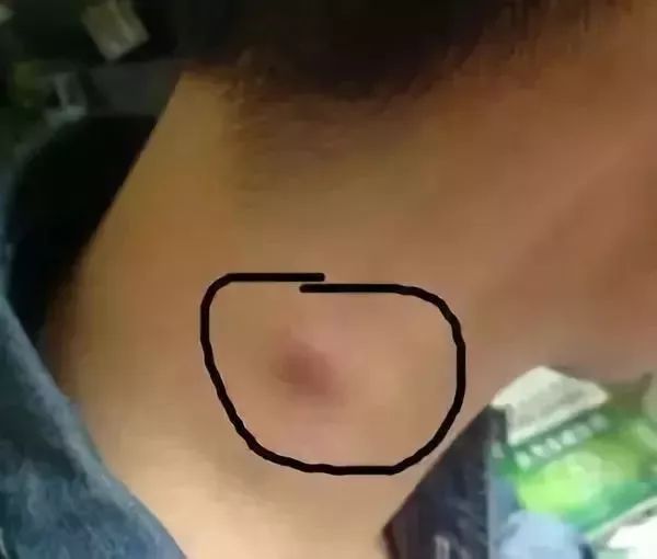 脖子上出现这3种东西，说明癌细胞已经醒了！-小辉娱乐网