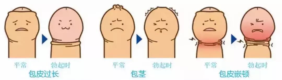 头粘连使包皮不能上翻,不能露出尿道口和.
