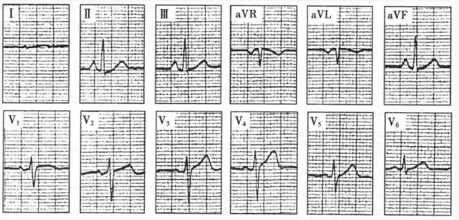 胸导联r波呈递增不良或呈qs型;往往有低电压,肺型p波;avl导联的p波