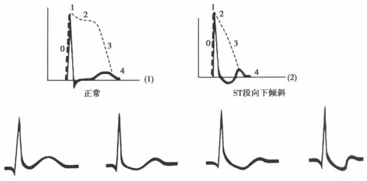 读图丨洋地黄中毒心电图图解及十大实情