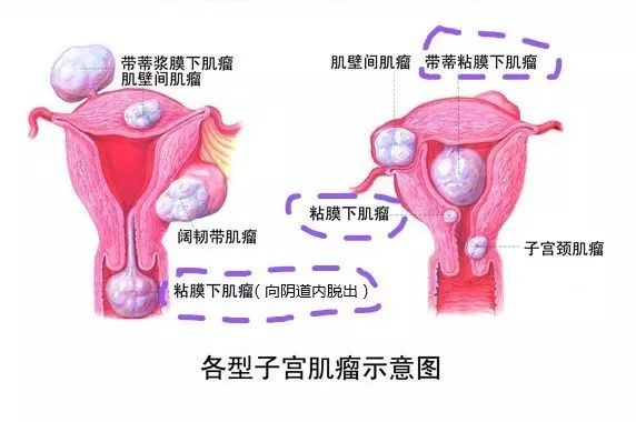 异常子宫出血的9种情况都在这里！