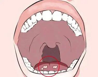 舌头上长了这种白斑没在意2个月后竟然癌变了杭州男子直呼后悔