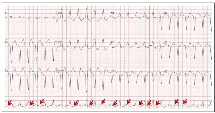 随后患者很快出现心悸,复查心电图(图3)示:宽qrs心动过速,房室分离