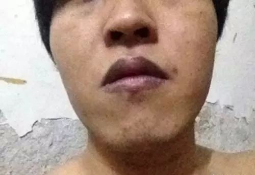 嘴唇一旦出现这个信号，马上去医院就诊