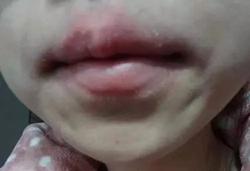 嘴唇一旦出现这个信号，马上去医院就诊