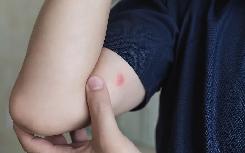 恙虫病可能出现严重的并发症,怀疑被恙虫咬伤,应尽早就医.