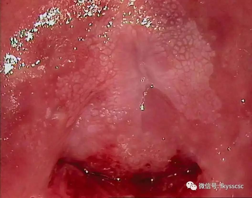 多图示例镜下6种异常宫颈图像的解读值得收藏