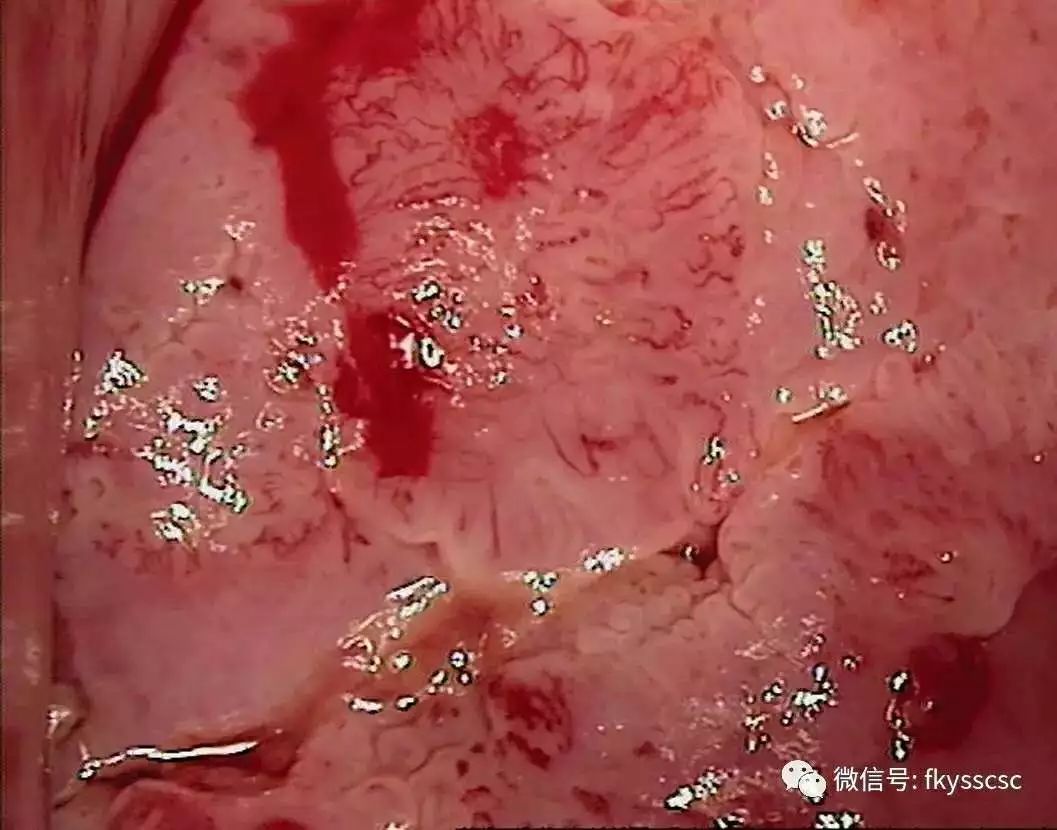 多图示例镜下6种异常宫颈图像的解读值得收藏