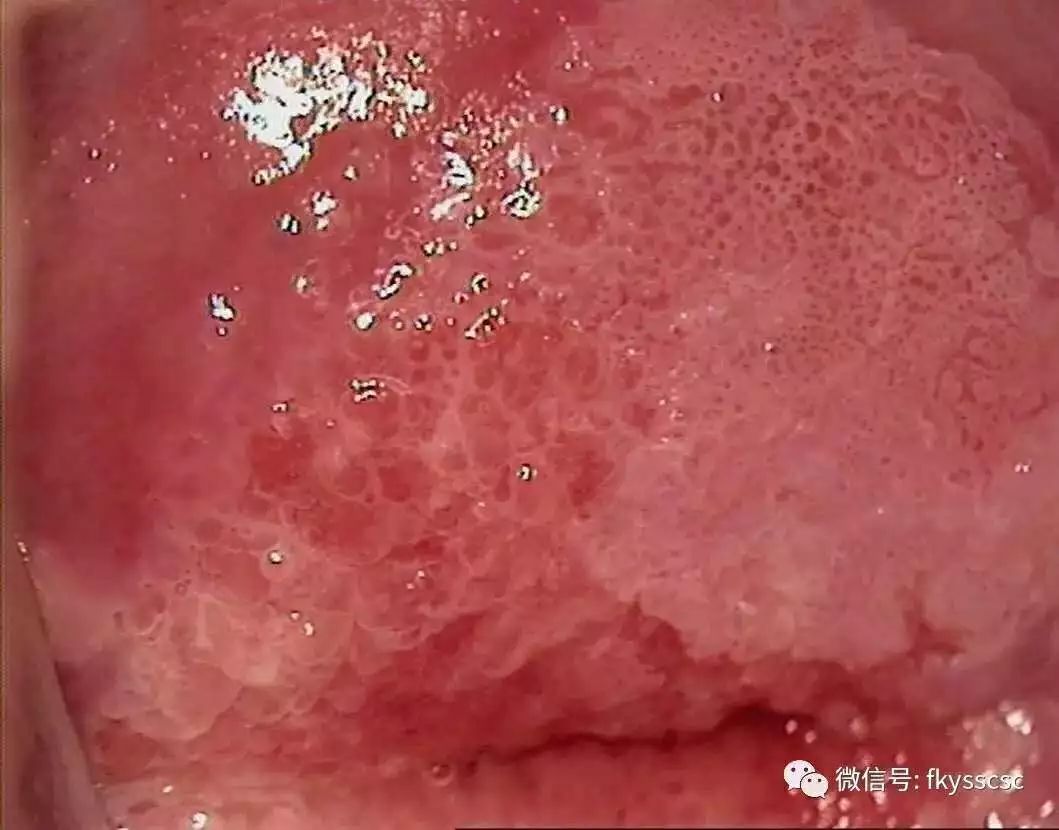 多图示例镜下6种异常宫颈图像的解读值得收藏