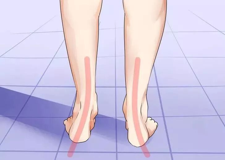 科普丨外八字脚对跑步的影响及其衍生伤病的治疗方式