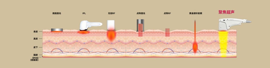 惠州震撼首发——超声王 技术升级 胶原“新”设备-小辉娱乐网