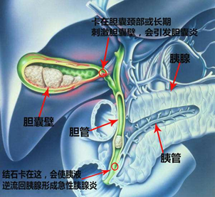 体检发现胆结石,该怎么办?