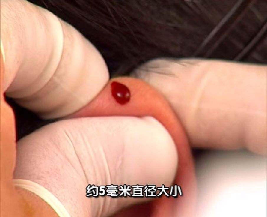 神奇的耳尖放血疗法,你知道多少?-爱妻自媒体