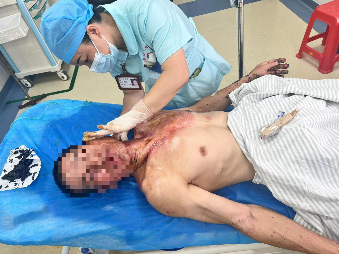 梅州一人被柏油烧伤！画面触目惊心-小辉娱乐网