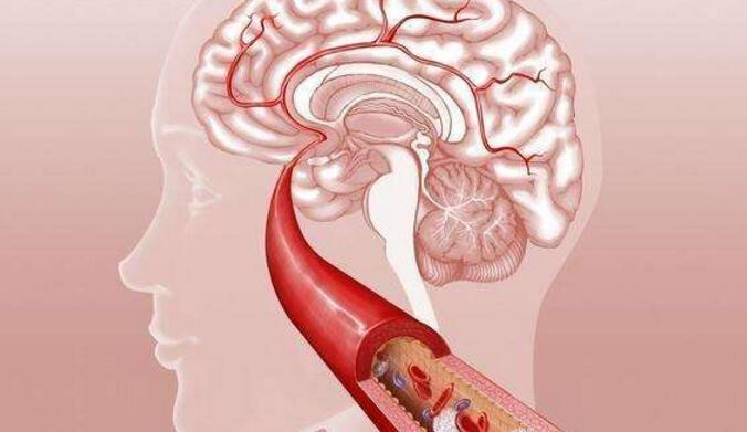 脑梗死、脑出血、脑卒中、脑中风一样吗？-小辉娱乐网