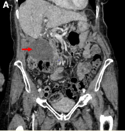 患者墨菲氏征阳性,是急性胆囊炎吗?|病例学习-爱妻自媒体
