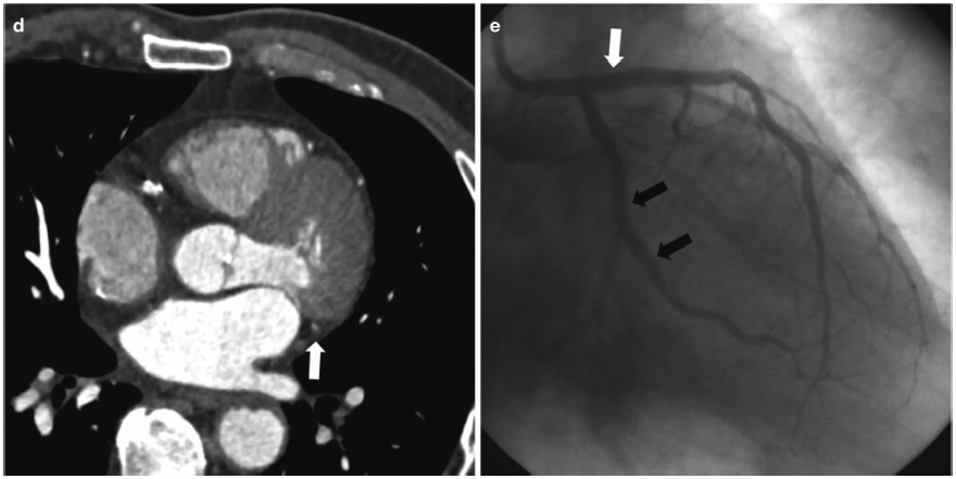 ct如何看冠状动脉狭窄高清图谱详解要点
