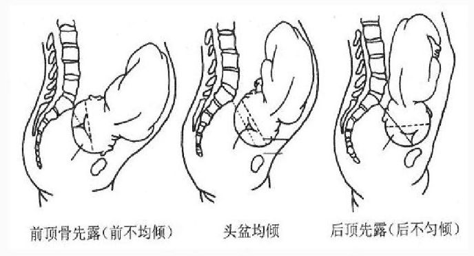 助产等均易发生肩难产.