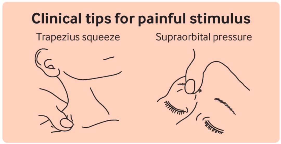痛苦刺激诱发去皮质强直回响(屈肘,肩内收,腿及踝部伸直):提醒丘脑