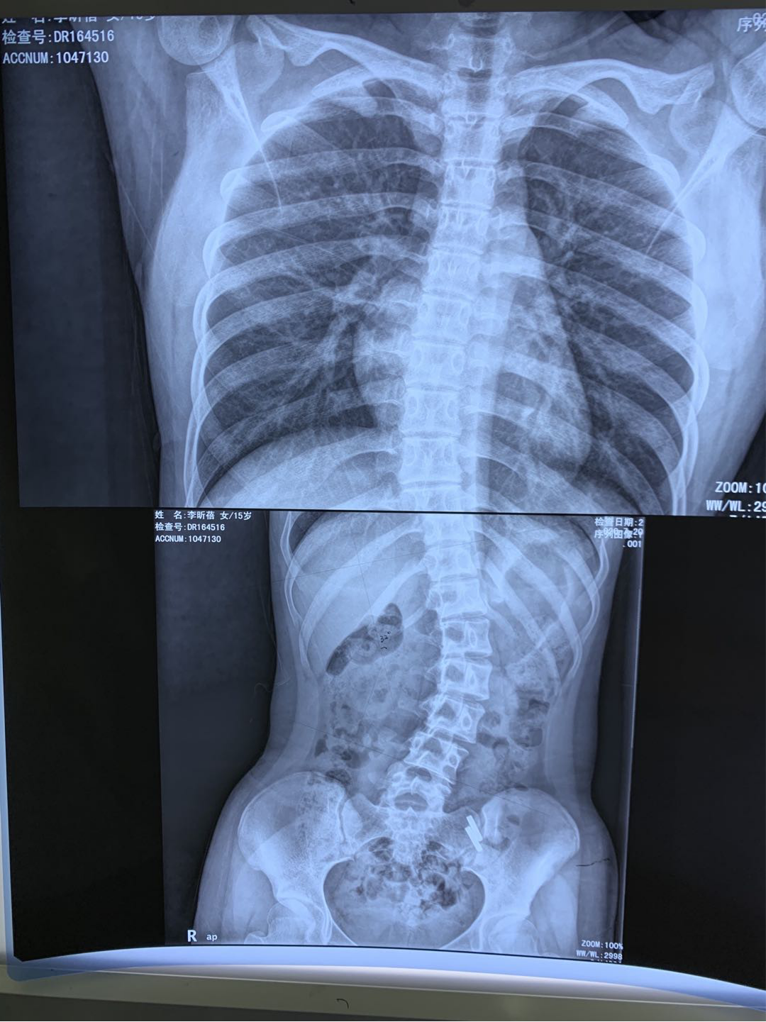 高低肩驼背歪脖子小心脊柱侧弯