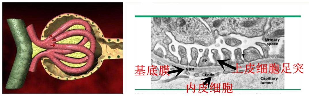 肾病综合征的孩子,正常的足细胞结构没有了,取而代之的是足突弥漫融合