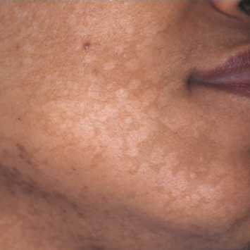 点我查察全图汗斑又叫花斑癣,在比来这种闷.