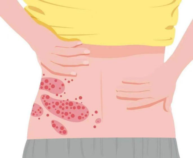 水痘高发期,战“痘”攻略快备好-小辉娱乐网