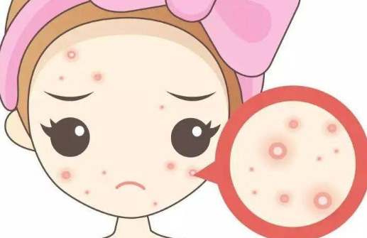 【肤康科普】祛痘方法要正确，这些事长痘不能做-小辉娱乐网